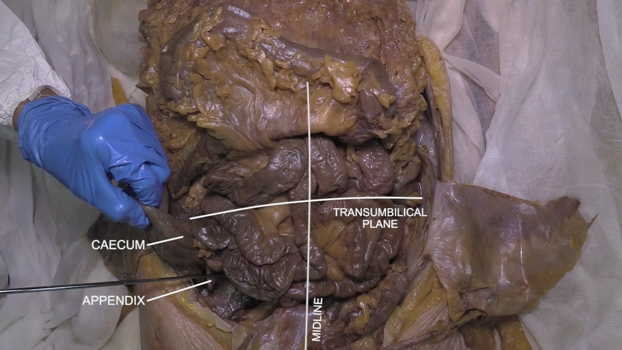 Labels (left to right): Caecum, appendix, midline, transumbilical plane