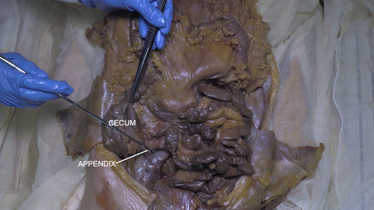 Labels (top to bottom): Cecum, appendix