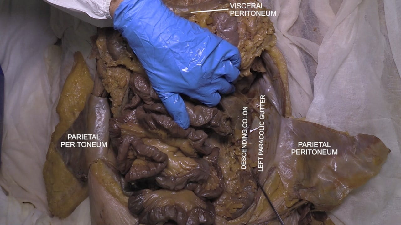 Labels (left to right): Parietal peritoneum, visceral peritoneum, descending colon, left parabolic gutter, parietal peritoneum