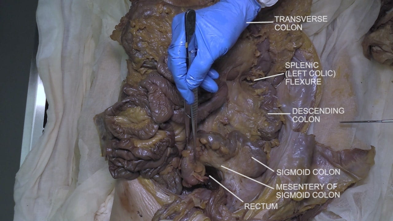 Labels (top to bottom): Transverse colon, splenic (left colic) flexure, descending colon, sigmoid colon, mesentery of sigmoid colon, rectum