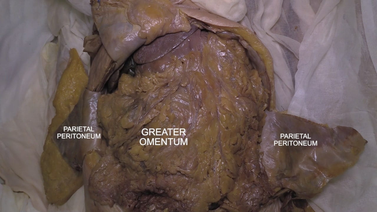 Labels (left to right): Parietal peritoneum, greater omentum, parietal peritoneum