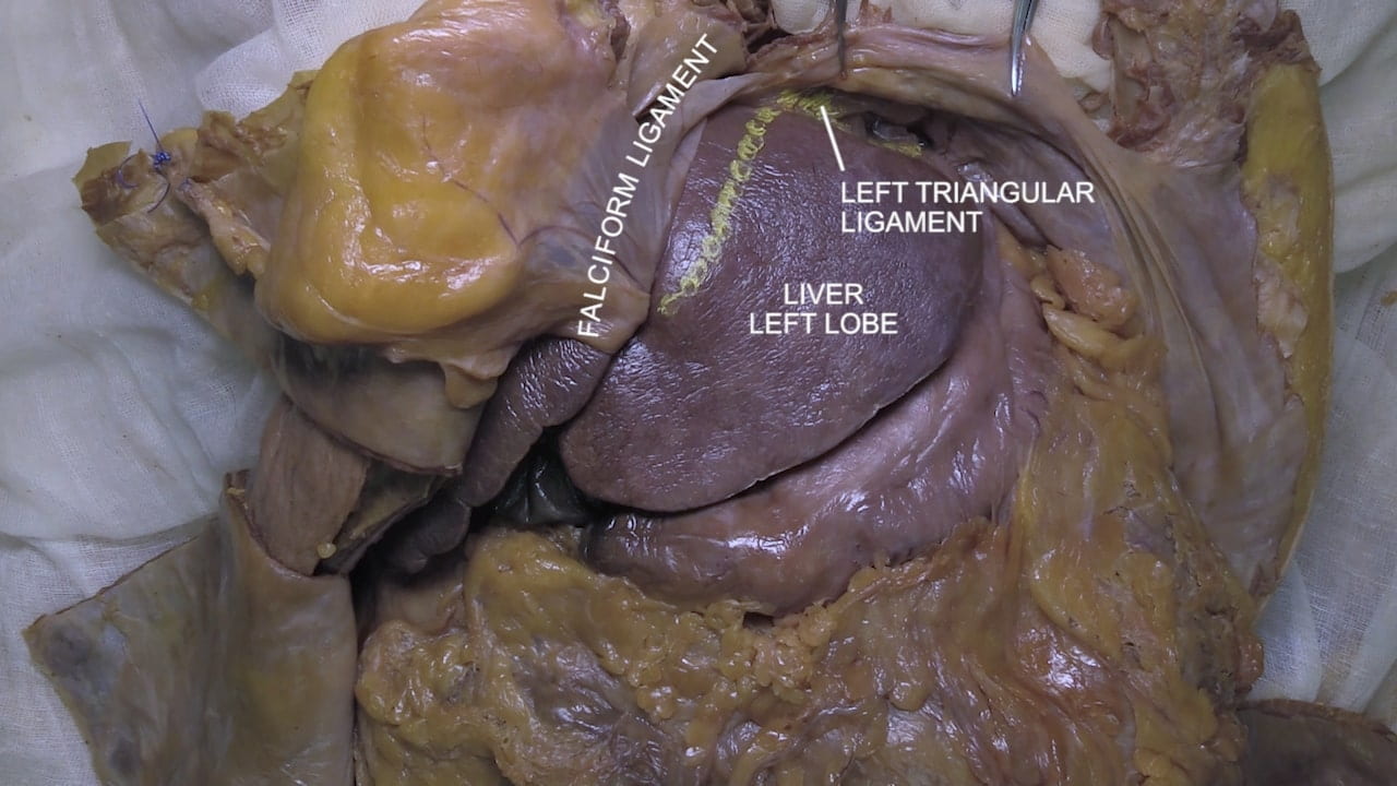 Labels (left to right): Falciform ligament, liver left lobe, left triangle ligament