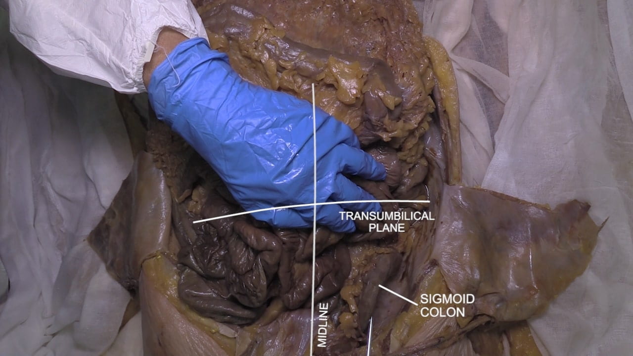 Labels (left to right): Midline, transumbilical plane, sigmoid colon