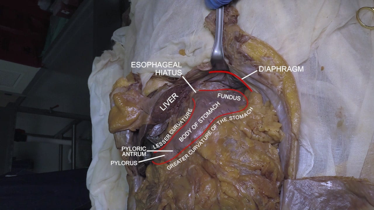 Labels (top to bottom): Esophageal hiatus, diaphragm, liver, fundus, lesser curvature, body of stomach, pyloric antrum, greater curvature of the stomach, pylorus