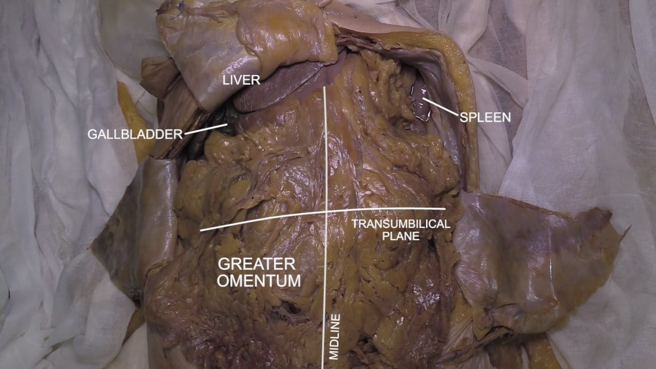 Labels (top to bottom): Liver, spleen, gallbladder, transumbilical plane, greater omentum, midline