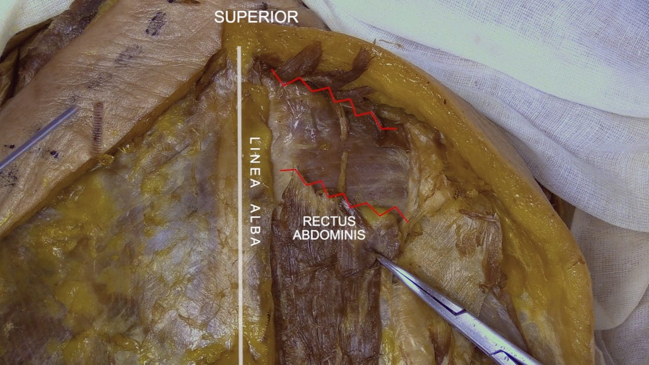 Labels (top to bottom): Superior, linea alba, rectus abdominis