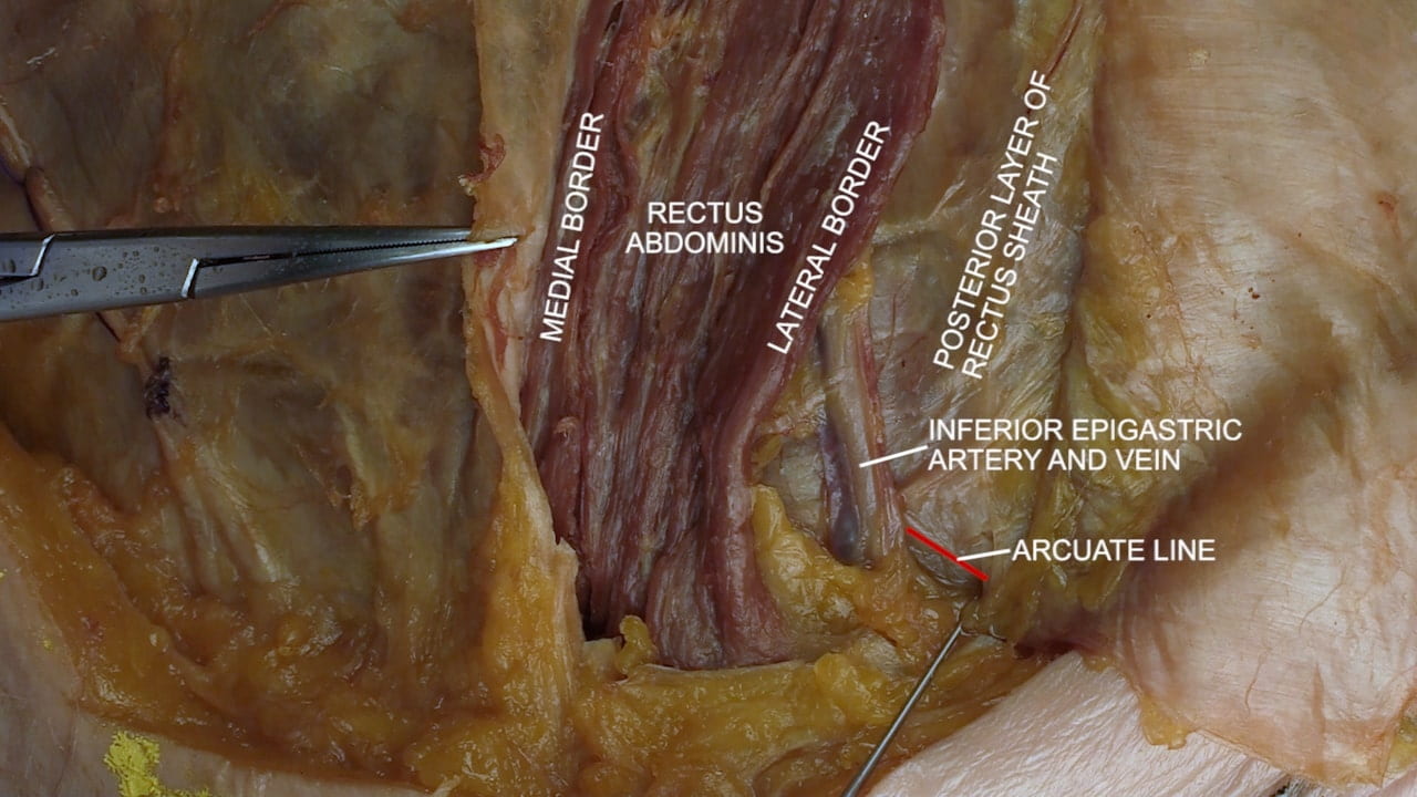 Labels (left to right): medial border, rectus abdominis, lateral border, posterior layer of rectus sheath, inferior epigastric artery and vein, arcuate line