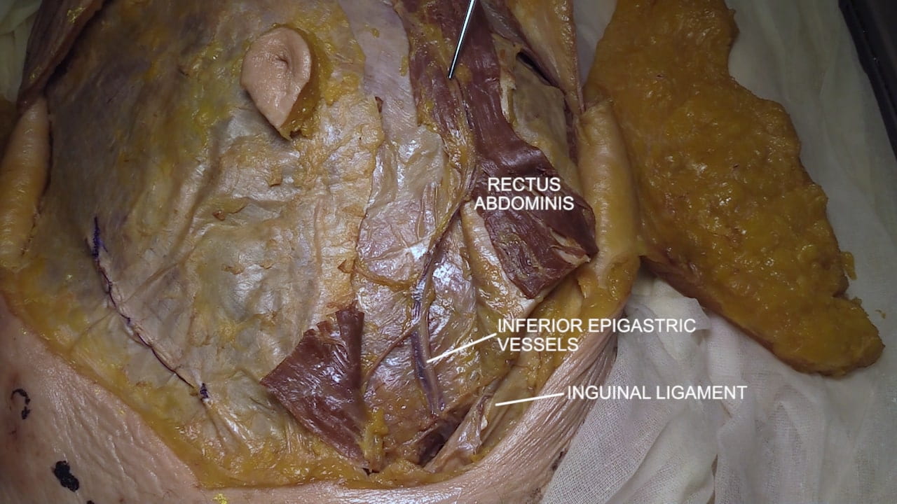 Labels (top to bottom): Rectus abdominis, inferior epigastric vessels, inguinal ligament