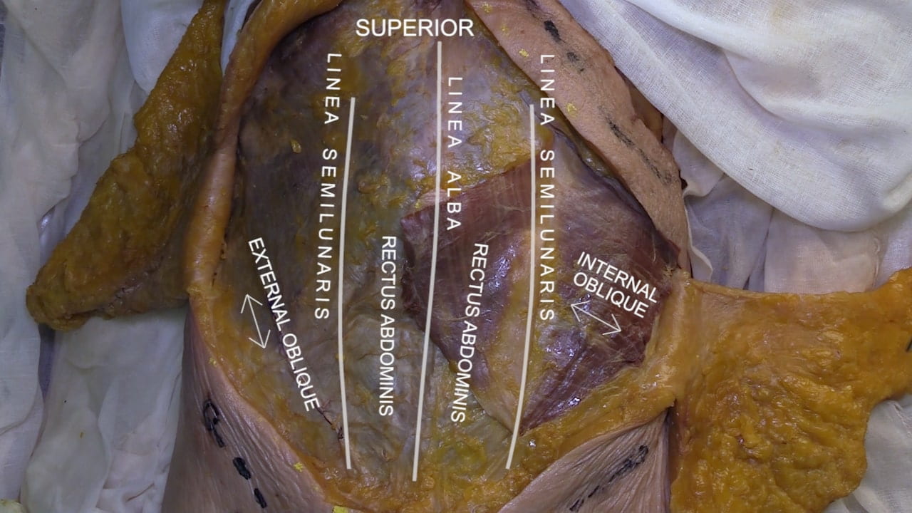 Orientation: Superior Labels (left to right): External oblique, linea semilunaris, rectus abdominis, linea alba, rectus abdominis, linea semilunares, internal oblique