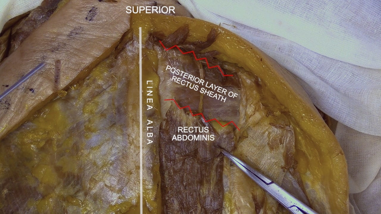 Labels (top to bottom): Superior, posterior layer of rectus sheath, linea alba, rectus abdominis