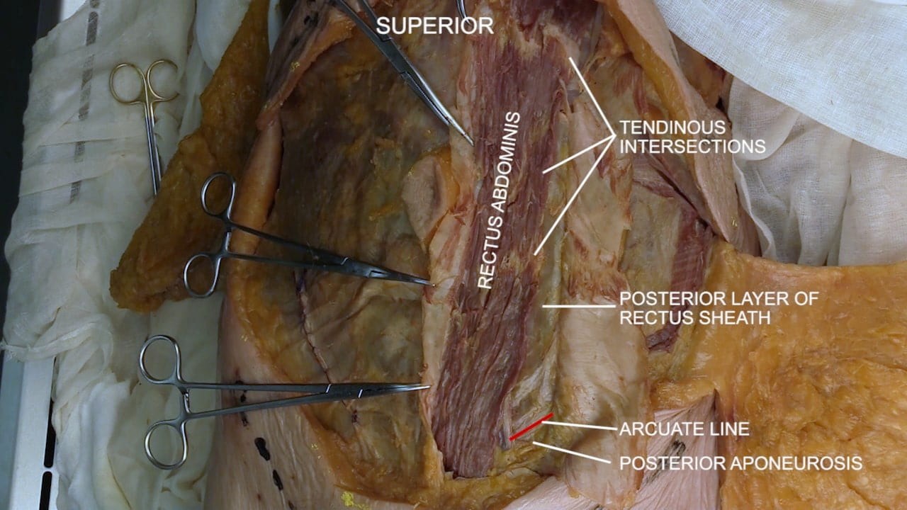 Orientation: Superior Labels (top to bottom): Tendinous intersections, rectus abdominis, posterior layer of rectus sheath, arcuate line, posterior aponeurosis