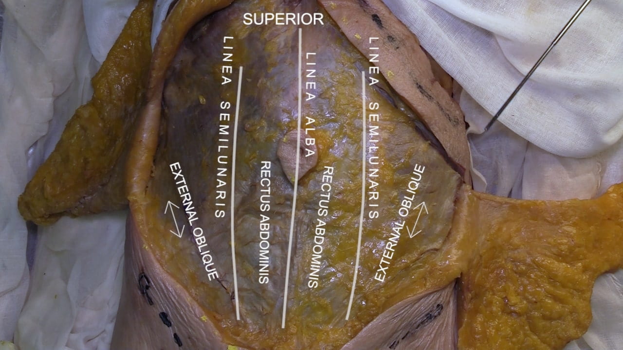 Orientation: Superior Labels (left to right): External oblique, linea semilunaris, rectus abdominis, linea alba, rectus abdominis, linea semilunares, external oblique