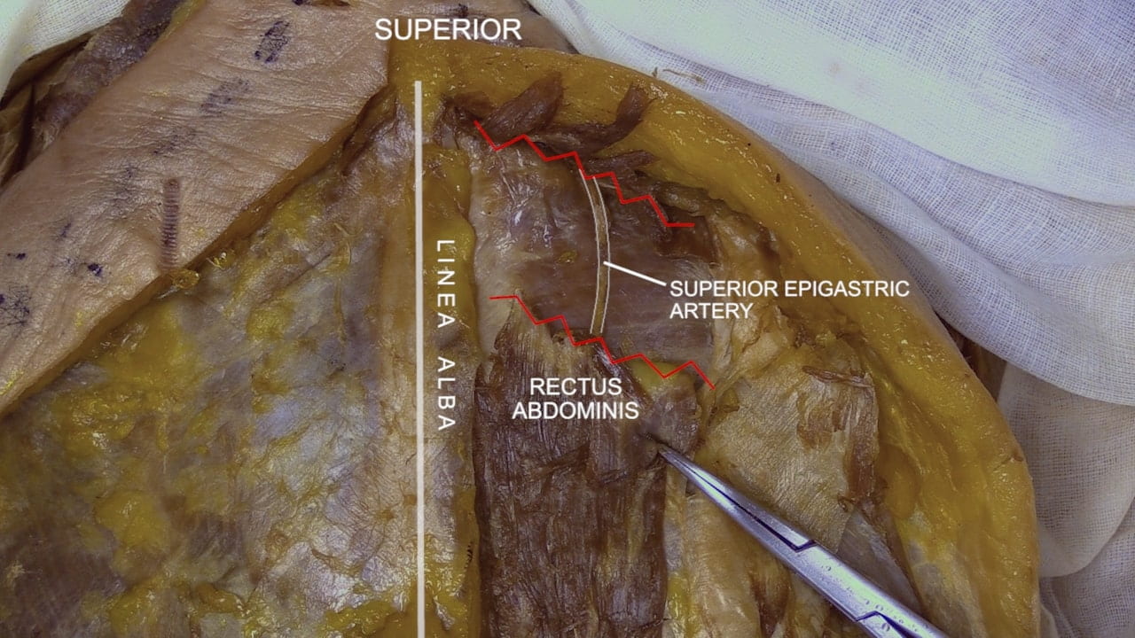 Labels (top to bottom): Superior, superior epigastric artery, linea alba, rectus abdominis