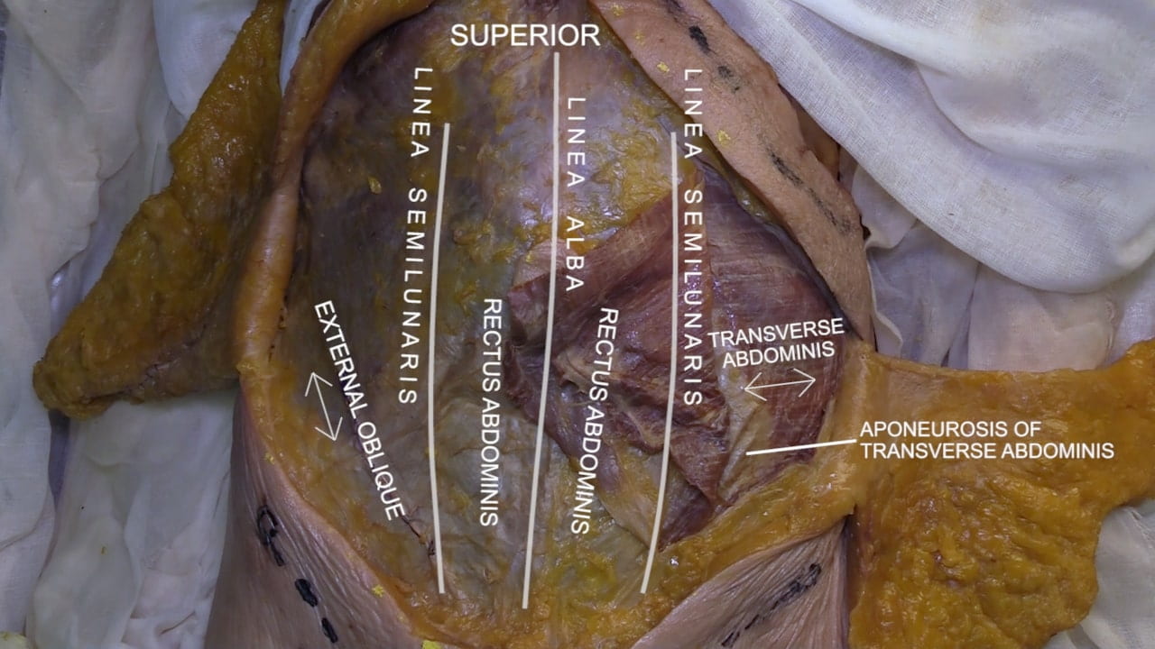 Orientation: Superior Labels (left to right): External oblique, linea semilunaris, rectus abdominis, linea alba, rectus abdominis, linea semilunares, transverse abdominis, aponeurosis of transverse abdominis