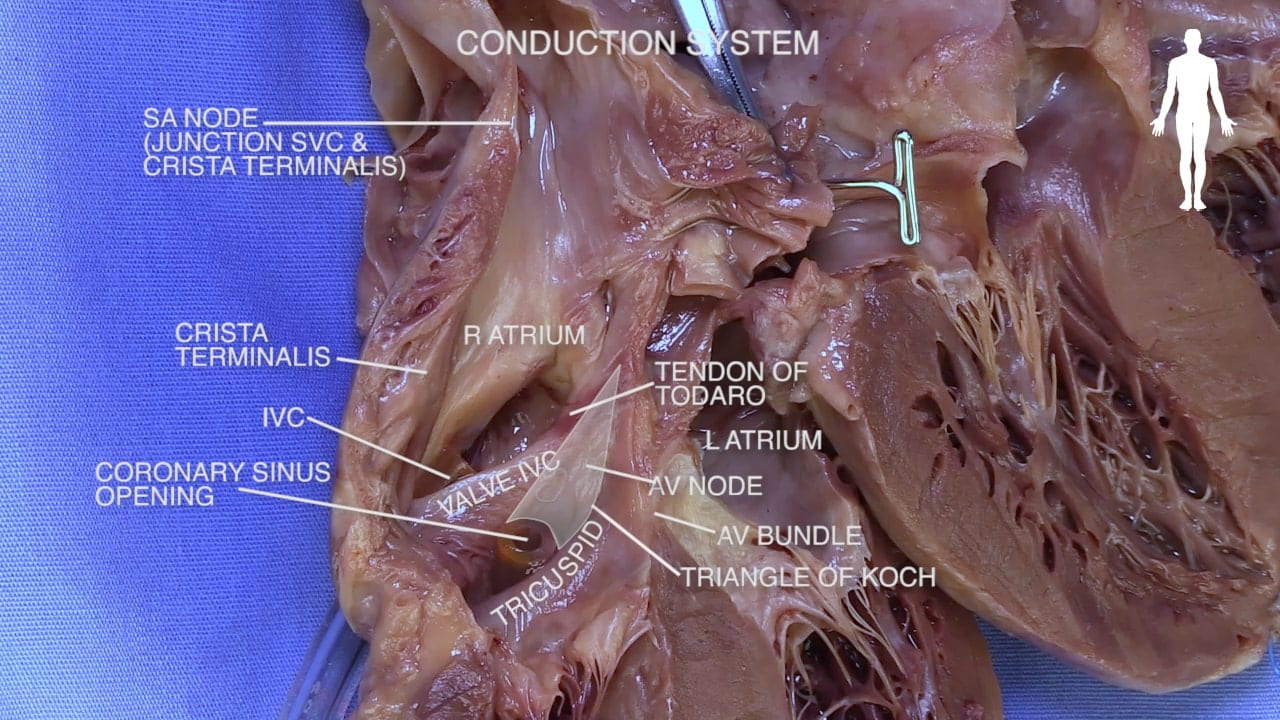 Title: Conduction system Labels (top to bottom): SA node (junction SVC & crista terminalis), crista terminalis, r atrium, tender of Todaro, IVC, l atrium, coronary sinus opening, valve IVC, AV node, AV bundle, tricuspid, triangle of Koch