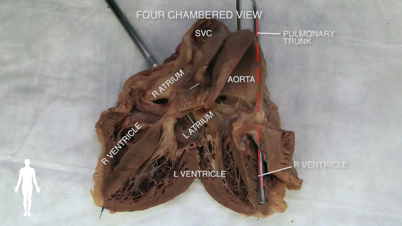 Title: Four chambered view Labeled (top to bottom): SVC, pulmonary trunk, r atrium, aorta, r ventricle, l atrium, l ventricle, r ventricle