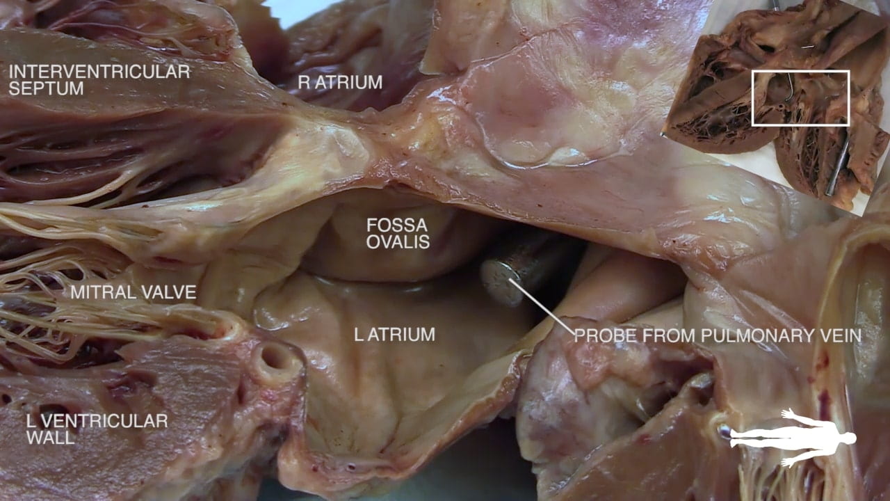 Labels (top to bottom): Interventricular septum, r atrium, fossa ovalis, mitral valve, l atrium, probe from pulmonary vein, l ventricular wall