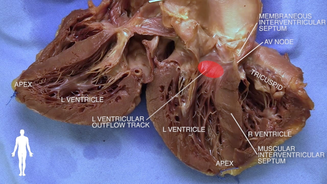 Labels (left to right): Apex, l ventricle, l ventricular outflow tract, l ventricle, apex, r ventricle, tricuspid, membraneous interventricular septum, av node, muscular interventricular septum