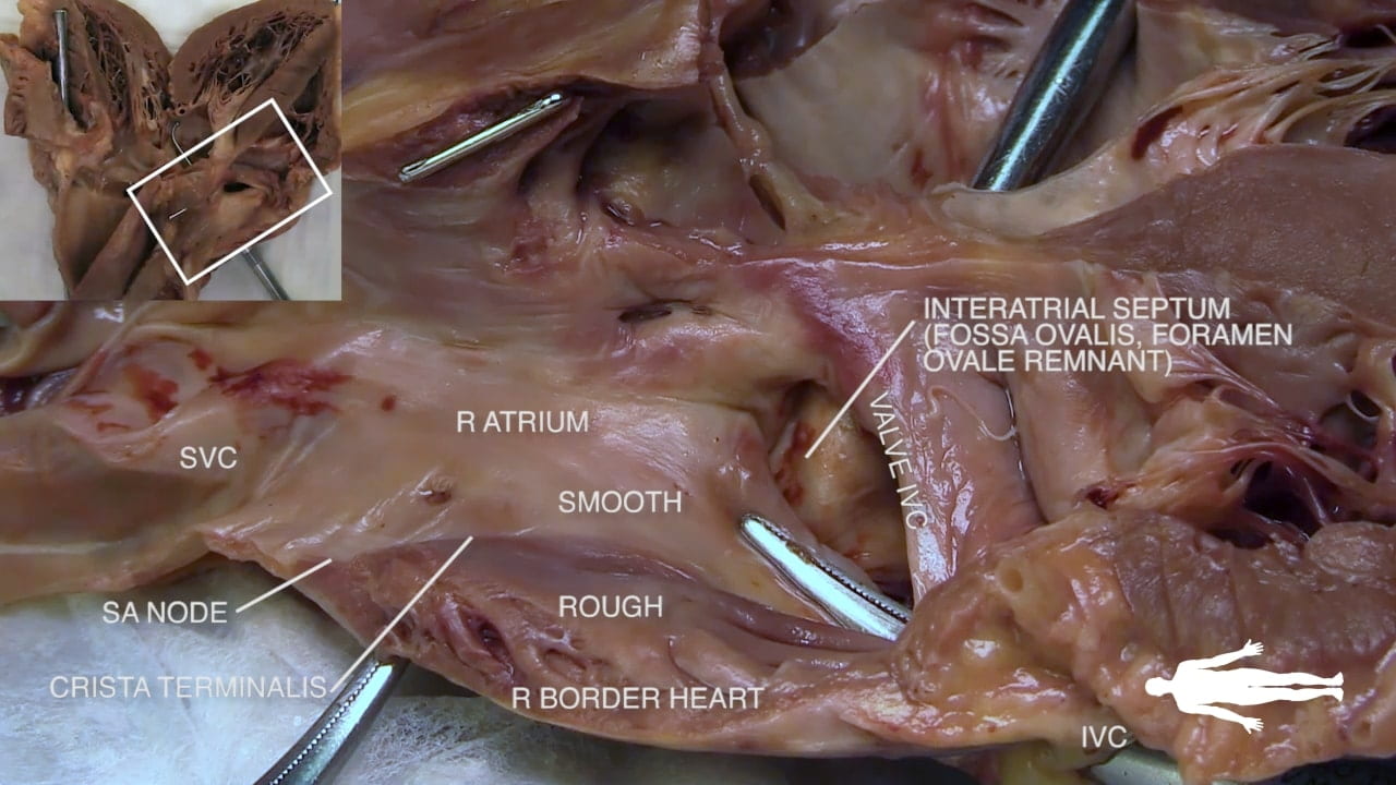 Labels (left to right): Crista terminalis, SA node, SVC, r atrium, smooth, rough, r border heart, valve IVC, interatrial septum (fossa ovalis, foramen ovale remnant), IVC