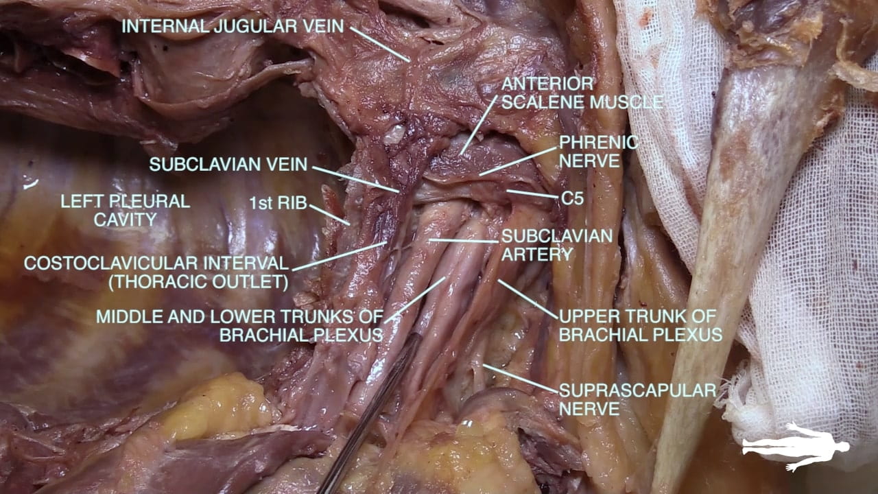 Labels (top to bottom): Internal jugular vein, anterior scalene muscle, phrenic nerve, subclavian vein, C5, 1st rib, left pleural cavity, subclavian artery, costoclavicular interval (thoracic outlet), middle and lower trunks of brachial plexus, upper trunk of brachial plexus, supra scapular nerve