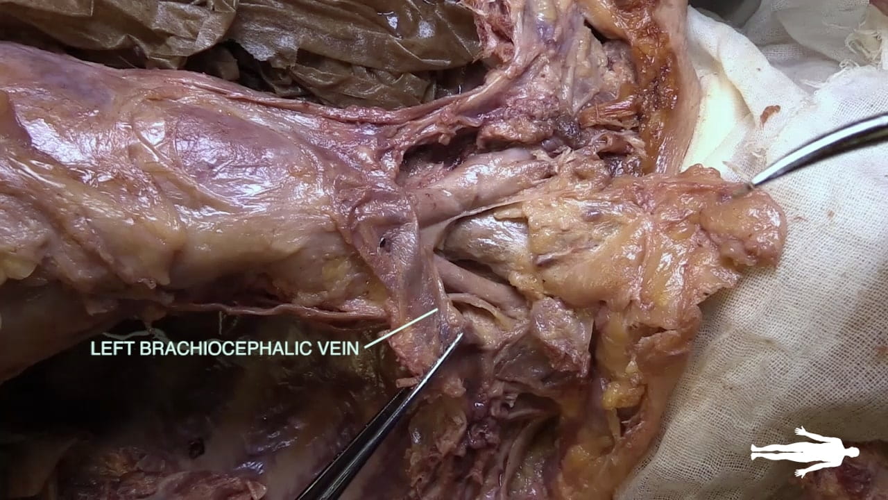 Label: Left brachiocephalic vein