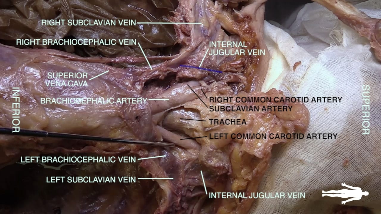 Labels (top to bottom): Right subclavian vein, right brachiocephalic vein, internal jugular vein, superior vena cava, brachiocephalic artery, right common carotid artery, subclavian artery, trachea, left common carotid artery, left brachiocephalic vein, left subclavian vein, internal jugular vein