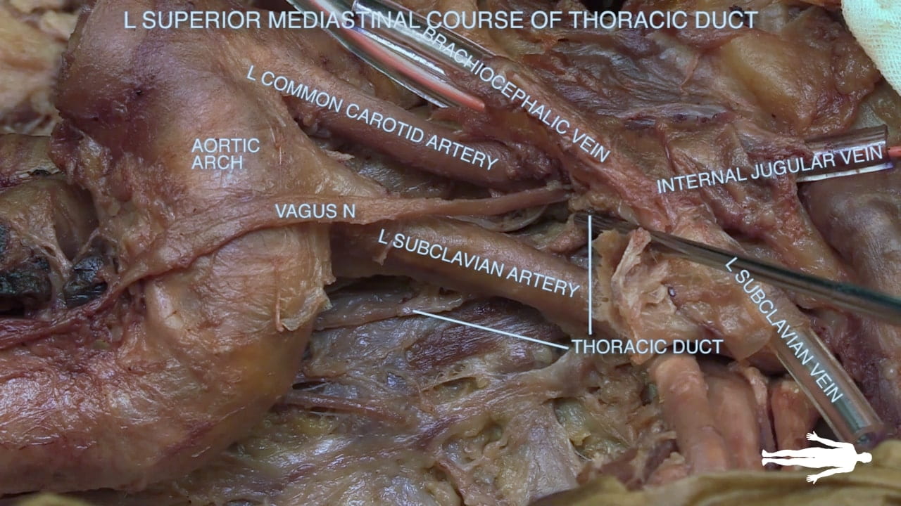 Title: L Superior mediastinal course of thoracic duct Labels (top to bottom): Brachiocephalic vein, l common carotid artery, aortic arch, internal jugular vein, vagus n, l subclavian artery, l subclavian vein, thoracic duct