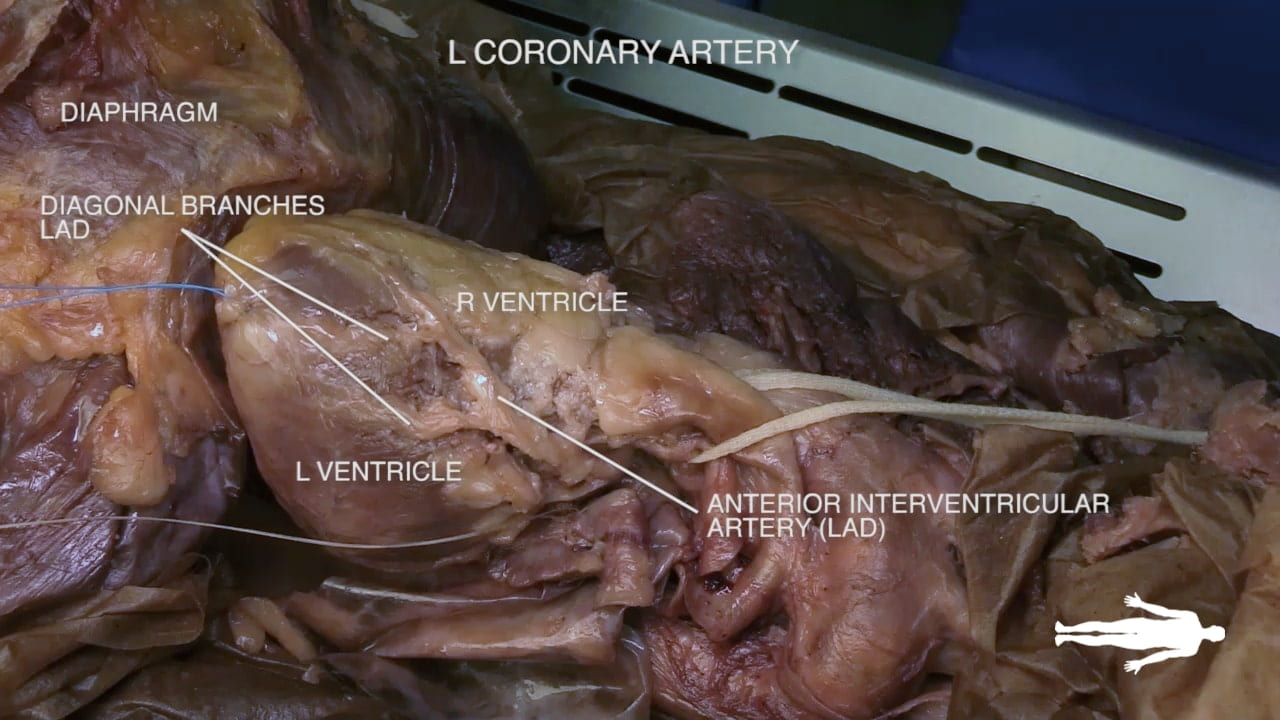 Title: L coronary artery Labels (left to right): Diaphragm, diagonal branches LAD, l ventricle, r ventricle, anterior interventricular artery (LAD)