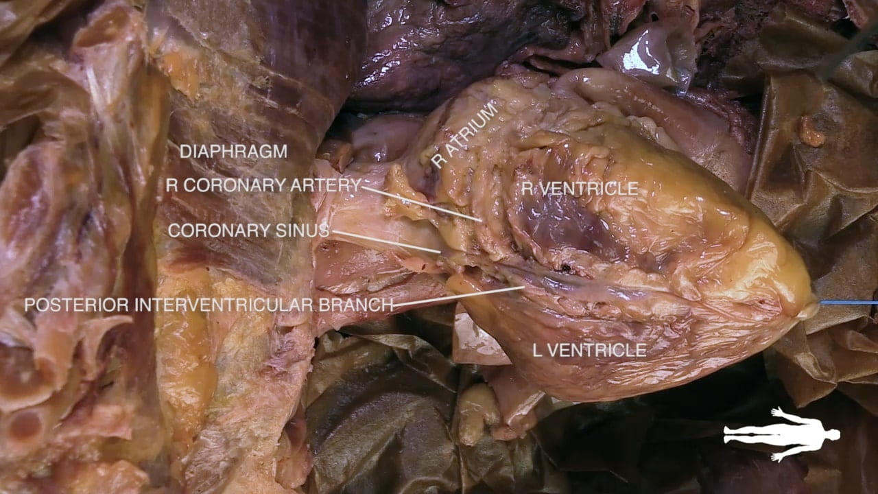 Labels (top to bottom): Diaphragm, r atrium, r coronary artery, r ventricle, coronary sinus, posterior interventricular branch, l ventricle