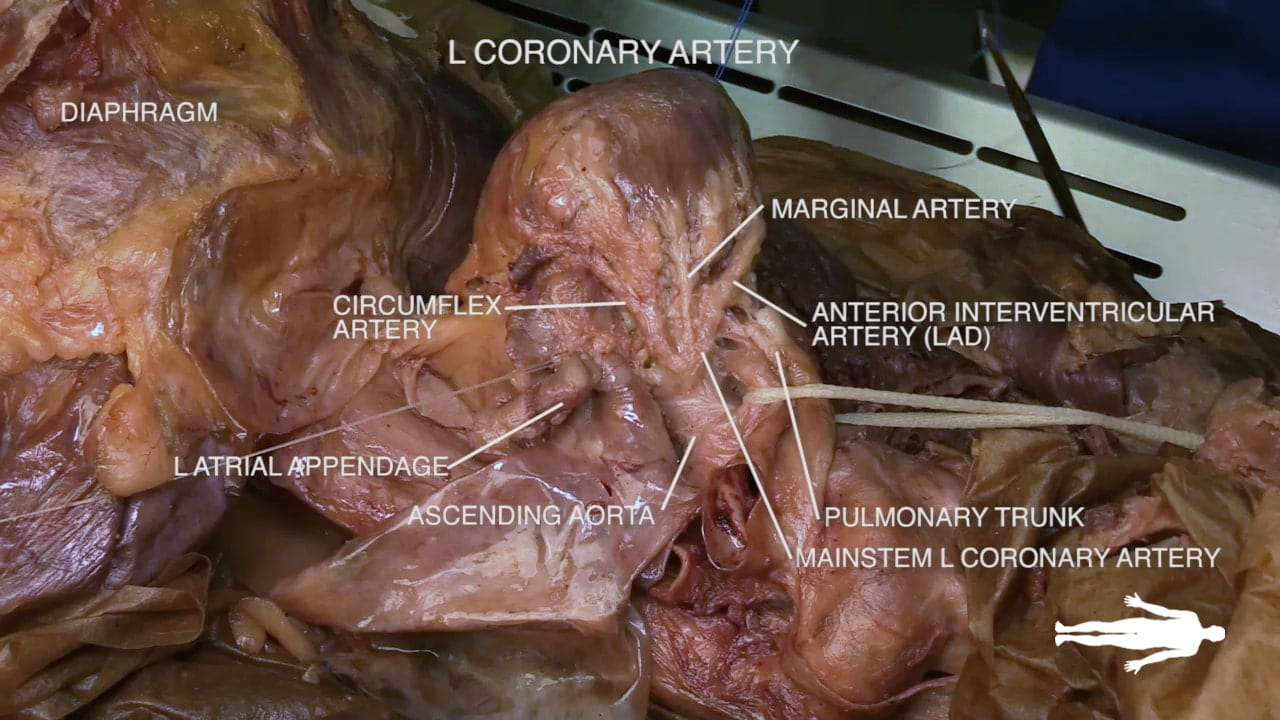 Title: L coronary artery Labels (left to right): Diaphragm, L atrial appendage, circumflex artery, ascending aorta, marginal artery, anterior interventricular artery (LAD), mainstem L coronary artery, pulmonary artery