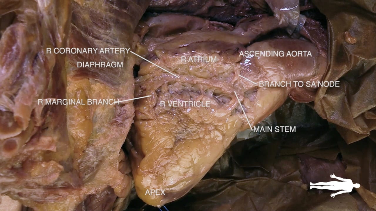 Labels (left to right): R marginal branch, r coronary artery, diaphragm, r ventricle, r atrium, ascending aorta, main stem, branch to sa node