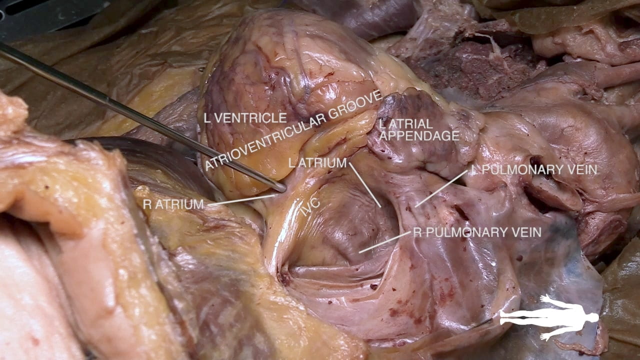 Labels (top to bottom): L ventricle, atrioventricular groove, l atrial appendage, l atrium, pulmonary vein, r atrium, ivc, r pulmonary vein