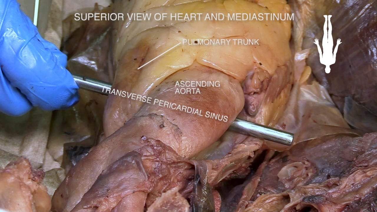 Title: Superior view of heart and mediastinum Labels (top to bottom): Pulmonary trunk, ascending aorta, transverse pericardial sinus