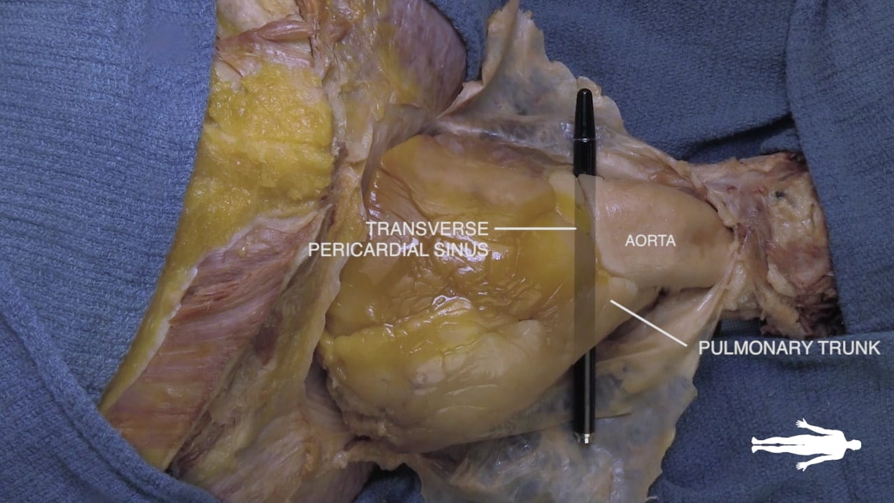 Labels (left to right): Transverse pericardial sinus, aorta, pulmonary trunk