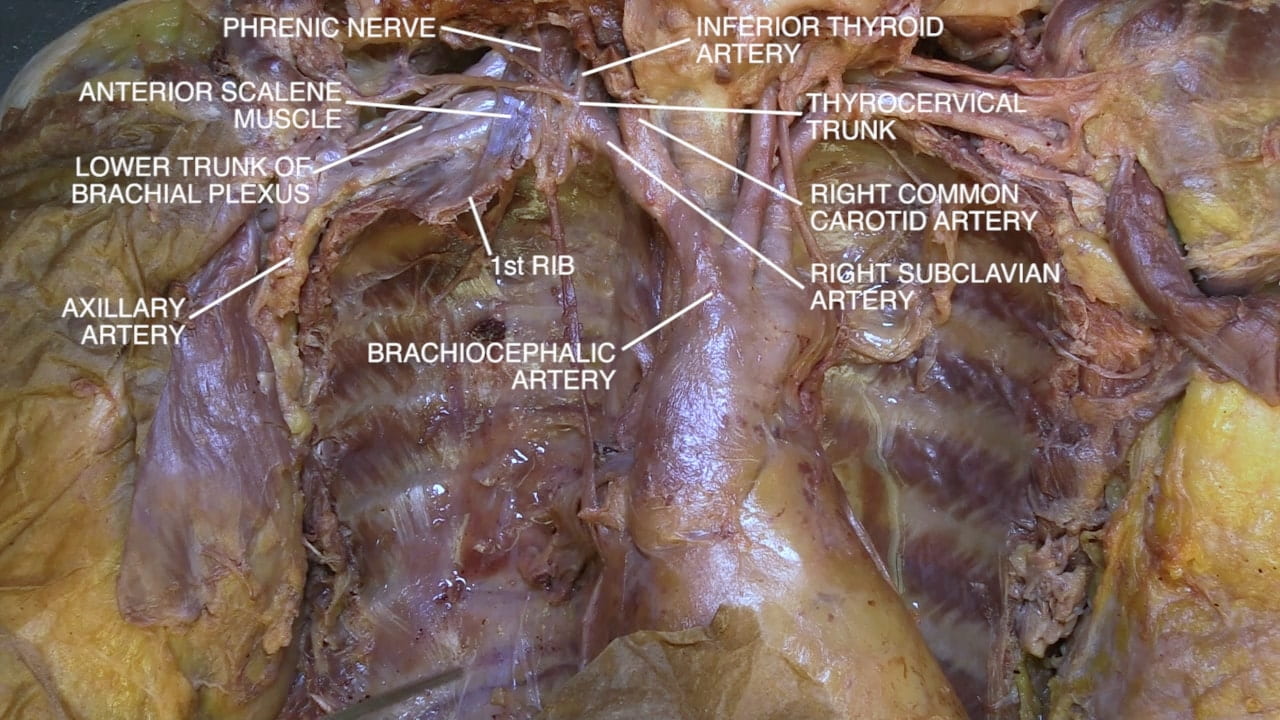 Labels (top to bottom): Phrenic nerve, inferior thyroid artery, anterior scalene muscle, thyrocervical trunk, lower trunk of brachial plexus, right common carotid artery, 1st rib, right subclavian artery, axillary artery, brachiocephalic artery