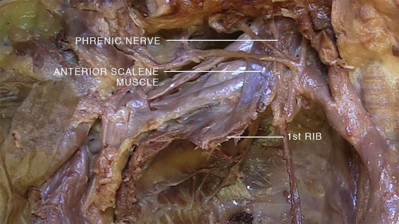 Labels (top to bottom): Phrenic nerve, anterior scalene muscle, 1st rib