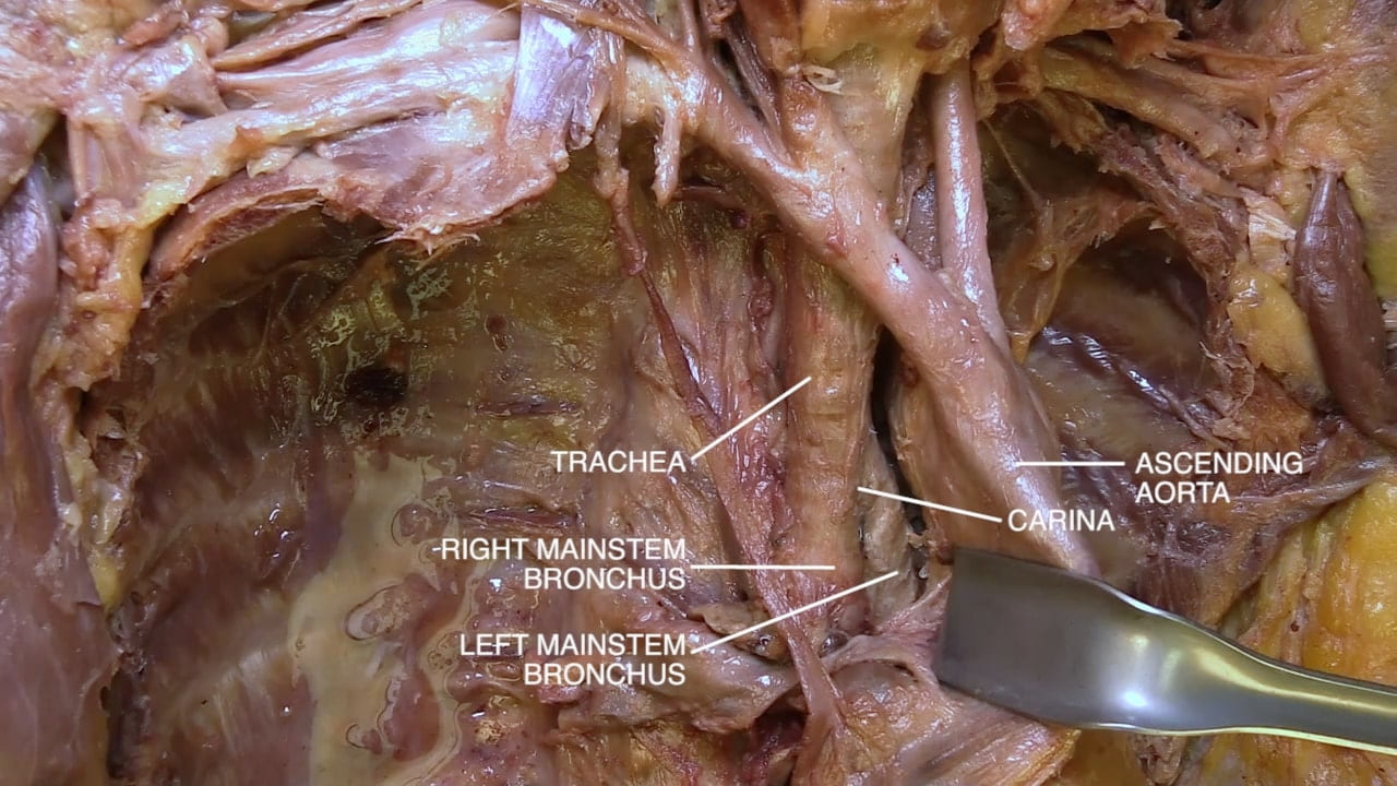 Labels (top to bottom): Trachea, ascending aorta, right mainstem bronchus, left mainstem bronchus