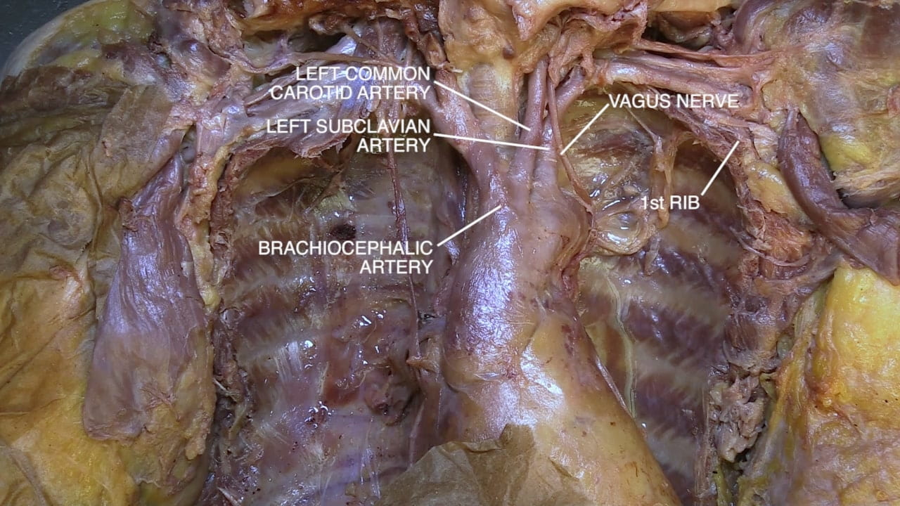 Labels (top to bottom): Left common carotid artery, vagus nerve, left subclavian artery, 1st rib, brachiocephalic artery