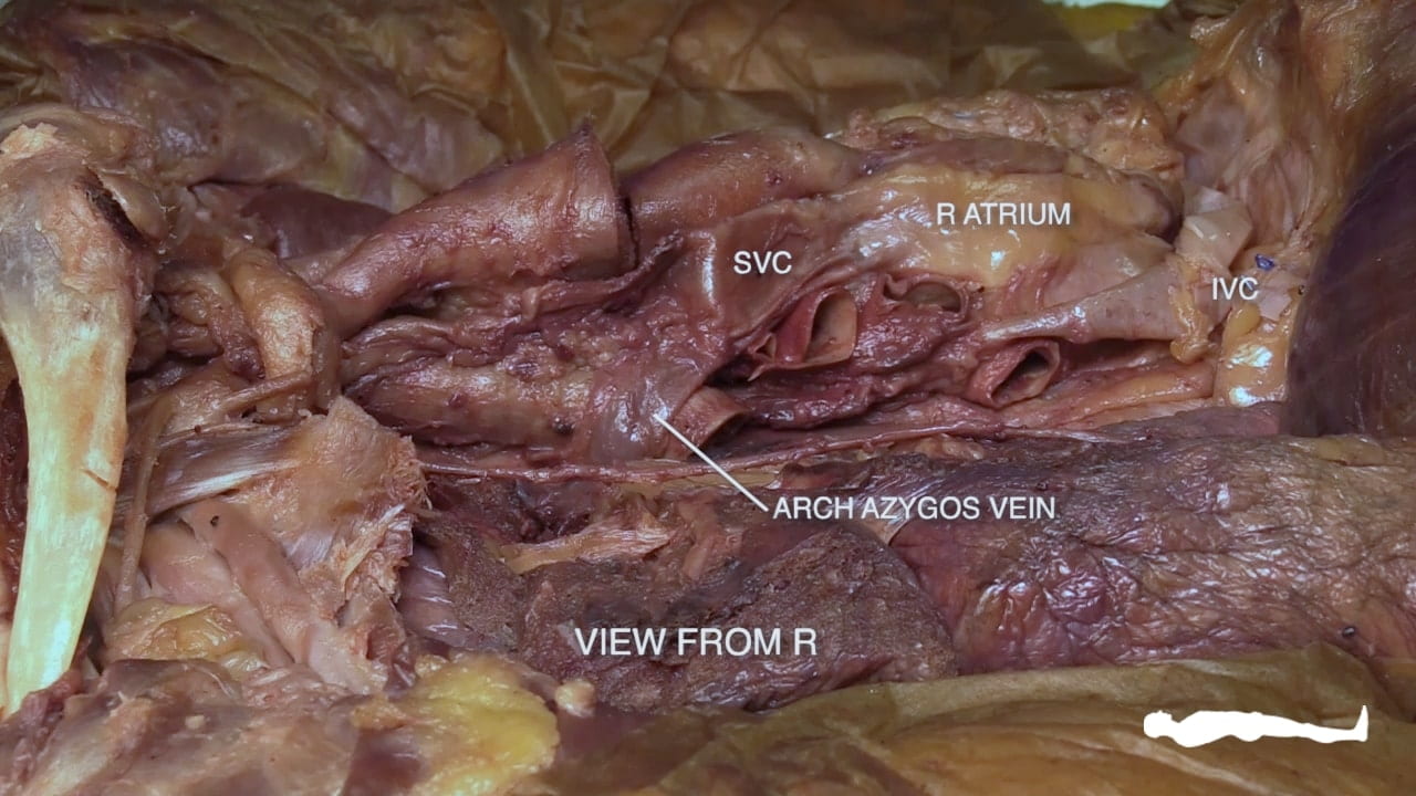 Labels (top to bottom) R atrium, SVC, IVC, arch azygos vein, view from R