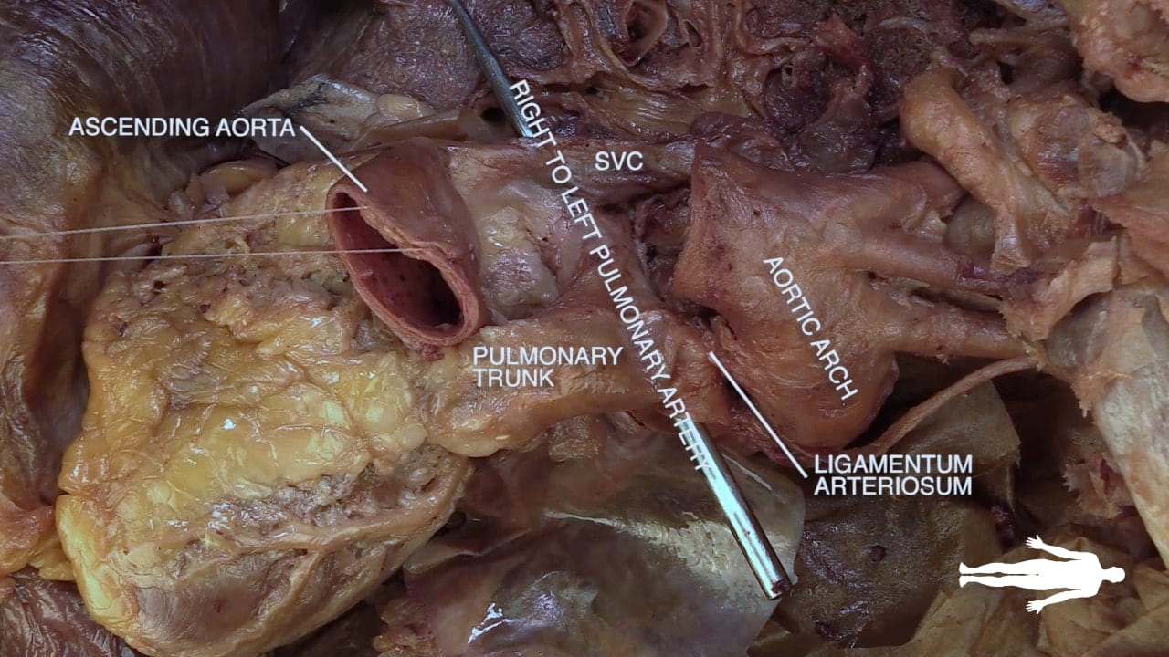 Labels (left to right): Ascending aorta, pulmonary trunk, right to left pulmonary artery, sac, aortic arch, ligamentum arteriosum