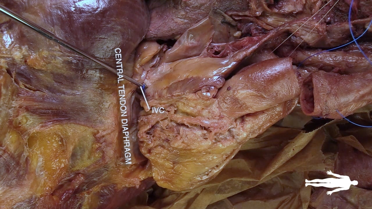 Labels (left to right): Central tendon diaphragm, IVC