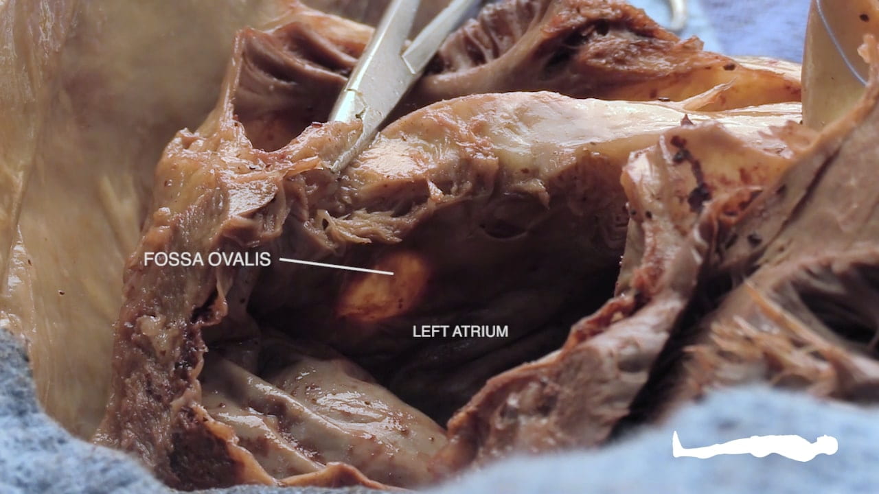 Labels (left to right): Fossa ovalis, left atrium