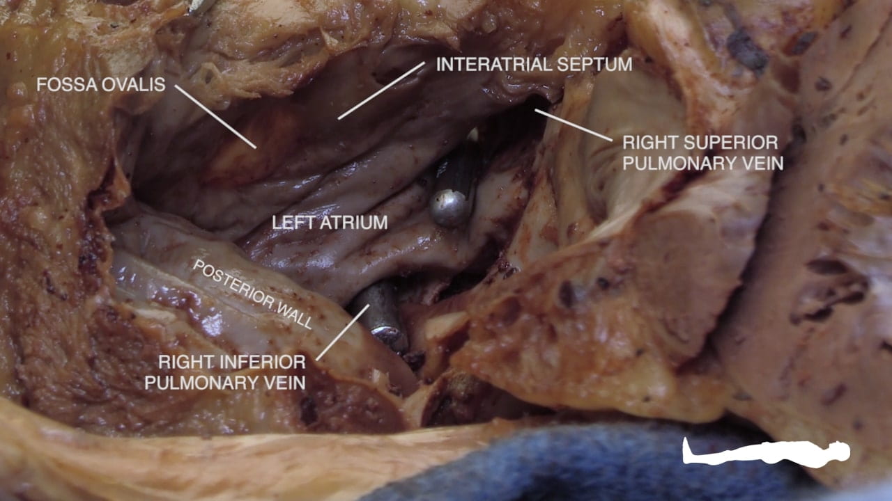 Labels (left to right): Fossa ovalis, right inferior pulmonary vein, posterior wall, left atrium, interatrial septum, right superior pulmonary vein