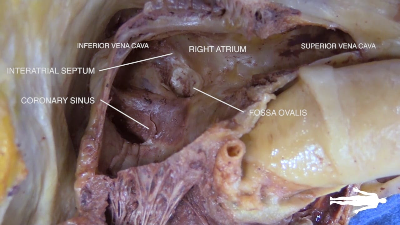 Labels (left to right): interatrial septum, coronary sinus, inferior vena cava, right atrium, fossa ovalis, superior vena cava