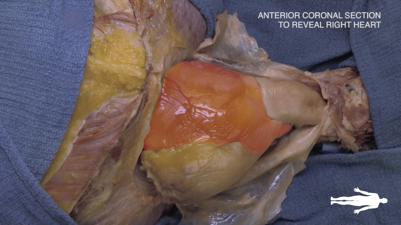 Title: Anterior coronal section to reveal right heart