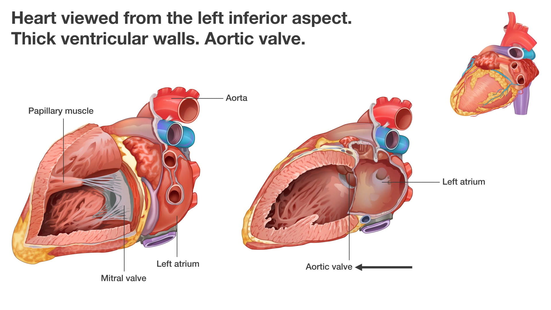 Text: Heart viewed from the left inferior aspect. Thick ventricular walls. Aortic valve. Labels (left to right): Papillary muscle, mitral valve, left atrium, aorta, aortic valve, left atrium