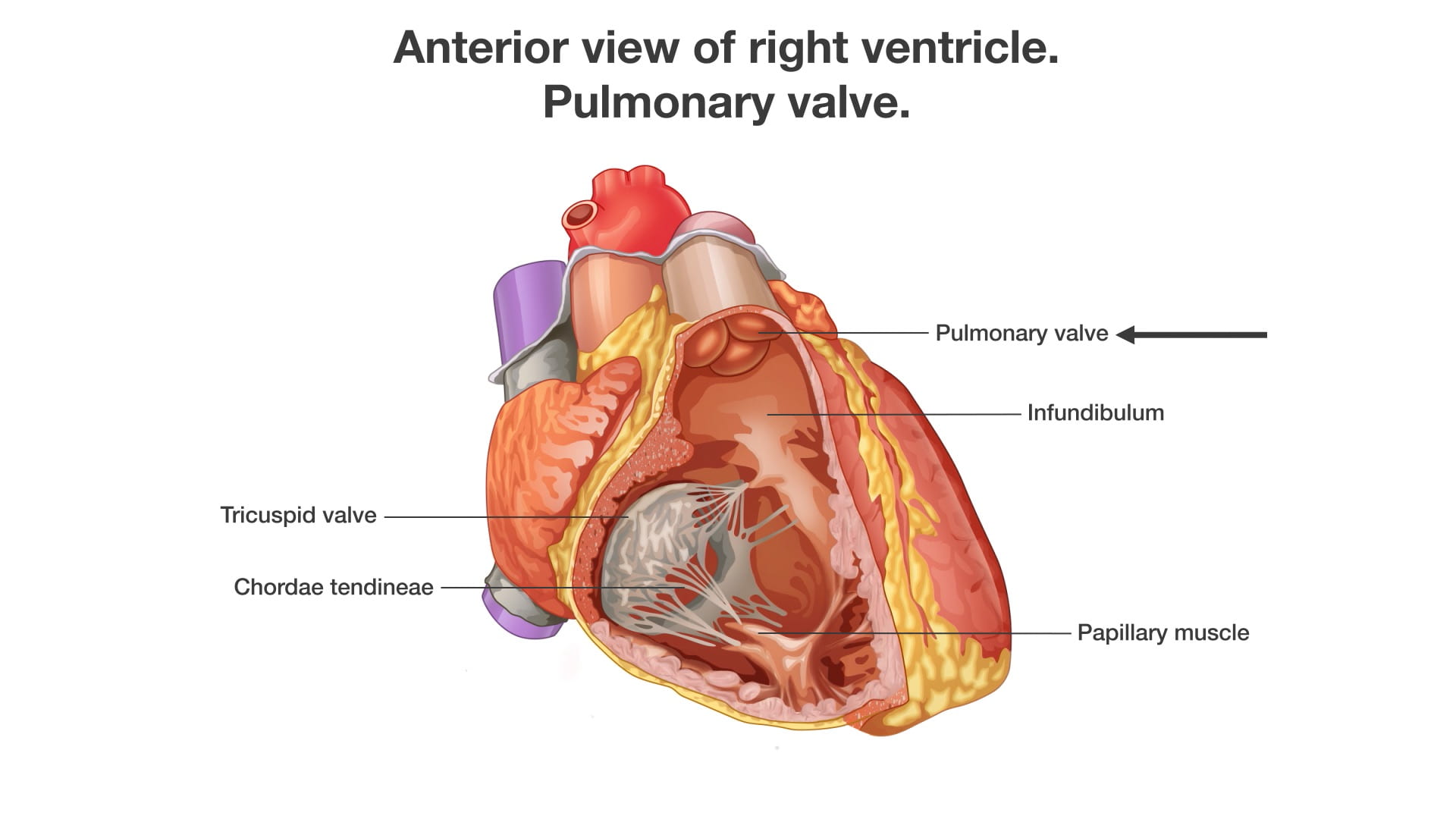 Labels (Left to right): Tricuspid valve, chordae tendineae, pulmonary valve, infundibulum, papillary muscle