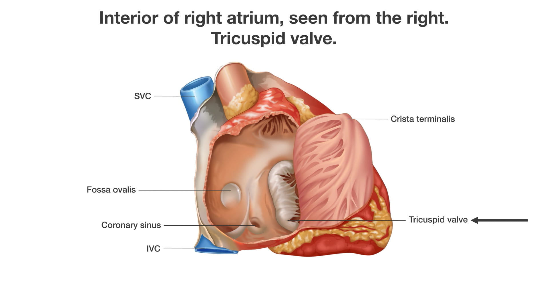 Labels (top to bottom): SVC, Crista terminalis, fossa ovalis, coronary sinus, tricuspid valve, IVC