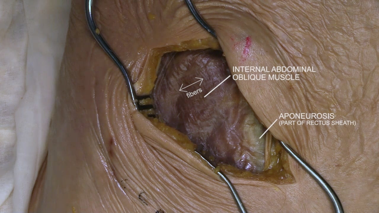 Labels (top to bottom): Internal abdominal oblique muscle, fibers, aponeurosis (part of rectus sheath)