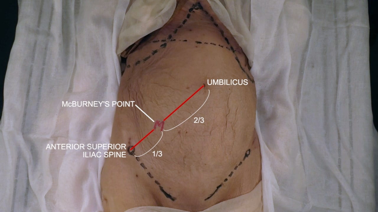 Labels (top to bottom): Umbilicus, McBurney's point, 2/3, anterior superior iliac spine, 1/3